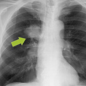 Radiographie pulmonaire avec suspicion de tumeur pour visualiser l'indice de cancérogénicité | © CRB Analyse Service GmbH